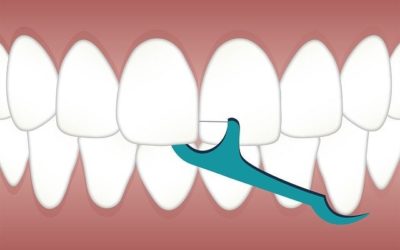 Cómo limpiar los implantes dentales