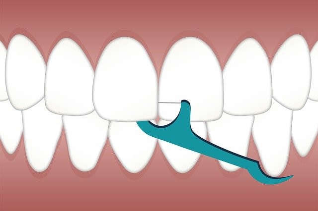 Cómo limpiar los implantes dentales