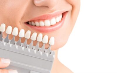 Escala de color de dientes: ¿Cuántos tipos de blancos existen?