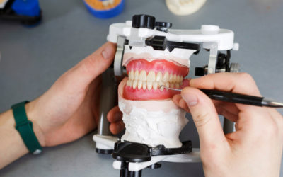 Puentes dentales: Qué son y qué tipos hay