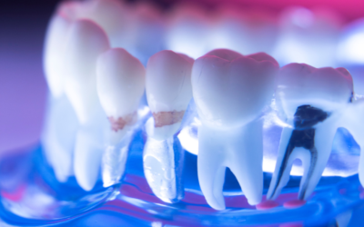Tipos de Endodoncia Dental